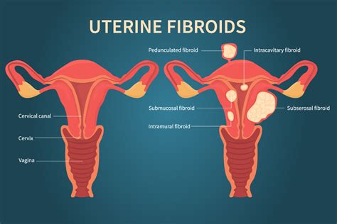 Feels like a bubble in my uterus. Things To Know About Feels like a bubble in my uterus. 